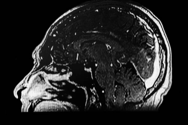 istock CAT - Scan of brain tumor. 1389345085