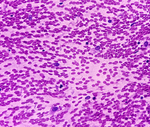 istock Atypical cells, smear show mostly regular oval to spindle shaped cells, mild pleomorphism, background shows blood. 1389450537