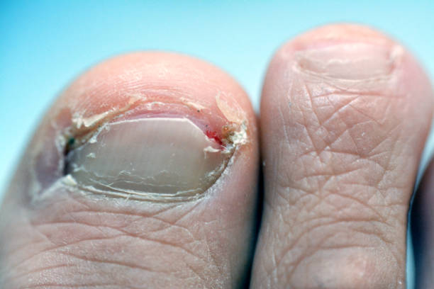 eingewachsener zehennagel der großen zehe des rechten fußes ist eine häufige erkrankung, bei der die ecke oder seite eines zehennagels in das weiche fleisch hineinwächst - podiatry chiropody toenail human foot stock-fotos und bilder