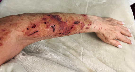 A caucasian woman's arm is covered with bites and bruises from a 7 week old puppy