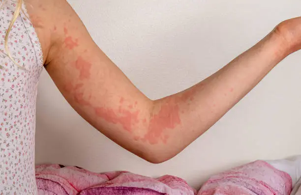 A girl´s arm with urticaria skin lesions (hives). Girl sitting on a bed, wearing a sleeveless top.