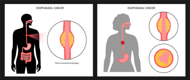 illustrazioni stock, clip art, cartoni animati e icone di tendenza di concetto di carcinoma esofageo - esofago