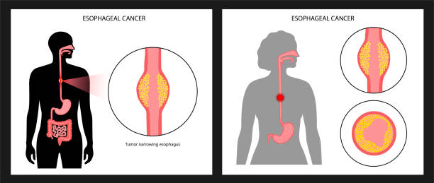 Esophageal carcinoma concept Esophageal carcinoma. Esophagus and stomach anatomy in the female body. Inflammation, pain, tumor in human digestive system. Internal organs exam concept. Oesophagus cancer flat vector illustration. esophagus cancer stock illustrations