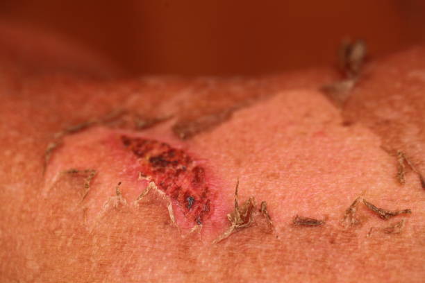sunburn skin  on the back of a man stock photo