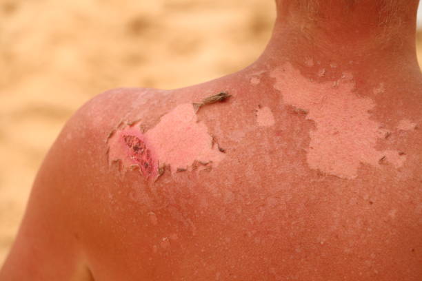Man shows scar of monkeypox and smallpox vaccine on arm