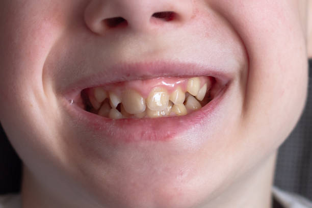istock A European boy shows uneven crooked teeth 1390069889