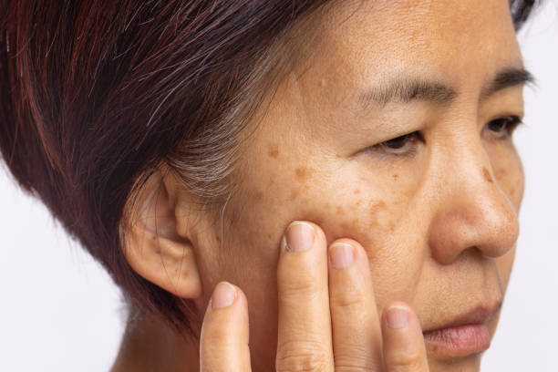 istock Menopausal women worry about melasma on face. 1390197541