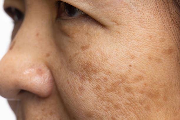 le donne in menopausa si preoccupano del melasma sul viso. - lentiggine foto e immagini stock