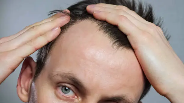 Photo of Young man with bald spots suffering from hair loss,