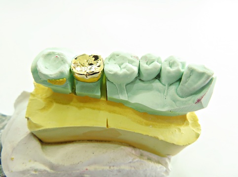 closeup for dental onlay on a molar tooth shown on a gypsum model