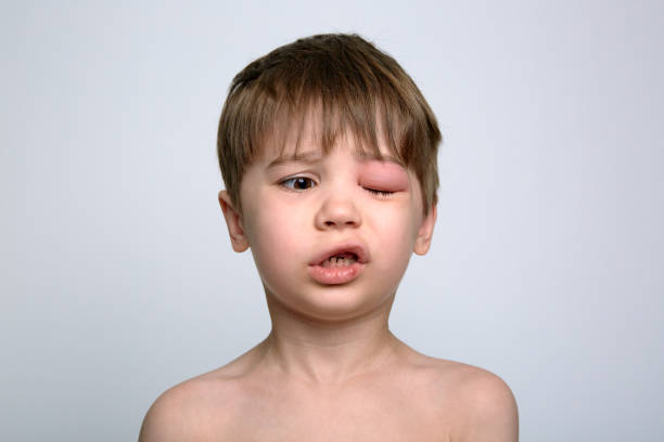 昆虫の咬傷から赤い腫れた目の子供。クインケ浮腫。不幸な少年の肖像画。孤立した背景。アレルギーのある人の顔。アレルギー。病気の体の部分。虐待または体罰の概念 - angioedema ストックフォトと画像