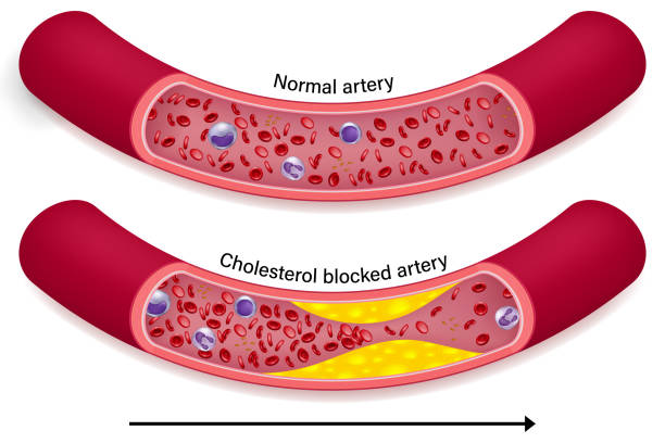 The difference of normal artery and cholesterol blocked artery. Clogged arteries caused by cholesterol. The difference of normal artery and cholesterol blocked artery. Clogged arteries caused by cholesterol. clogged artery stock illustrations