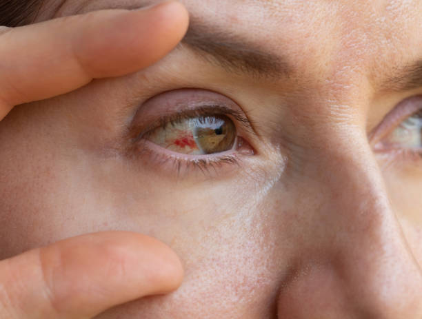 subconjunctival hemorrhage, bust blood vessel in eye, bloodshot eye close up stock photo