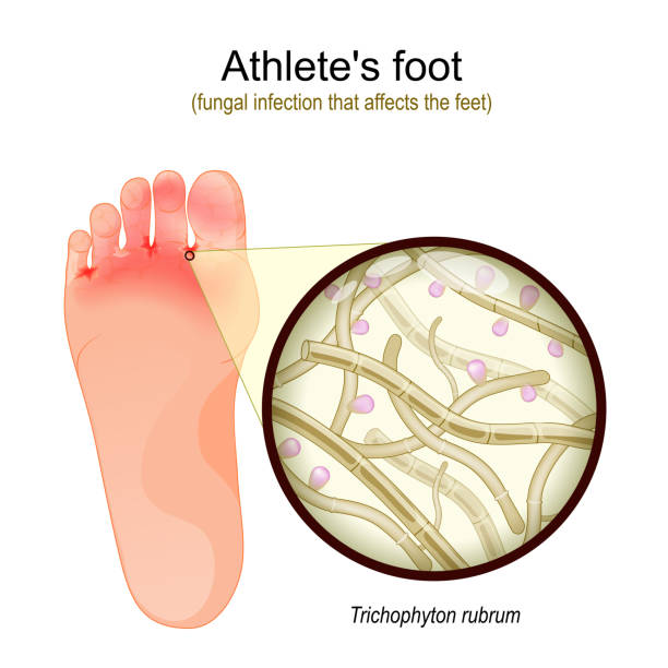 Athletes foot. Close-up of Trichophyton rubrum Athlete's foot is a fungal infection that affects the feet. sole of foot with parasitic fungus. Close-up of Trichophyton rubrum Fertile Hyphae, Macroconidia and Microconidia. Vector illustration tinea stock illustrations