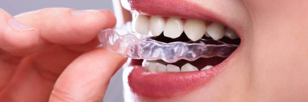 istock Woman Putting Transparent Aligner In Teeth 1390560389