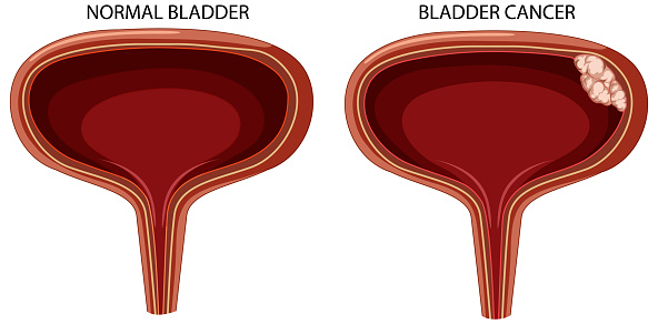 Stage of bladder cancer illustration