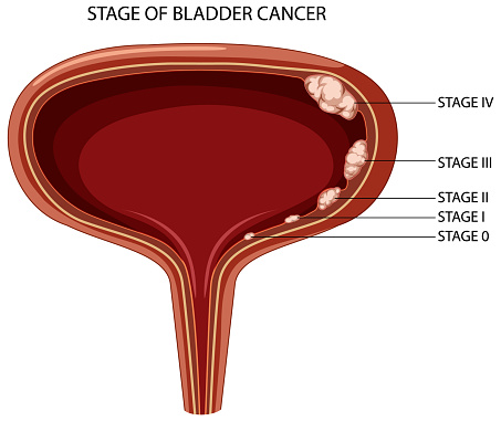 Stage of bladder cancer illustration