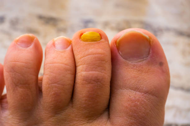 nahaufnahme der zehennägel mit einem mit pilz infizierten nagel, häufige erkrankungen und infektionen - podiatry chiropody toenail human foot stock-fotos und bilder