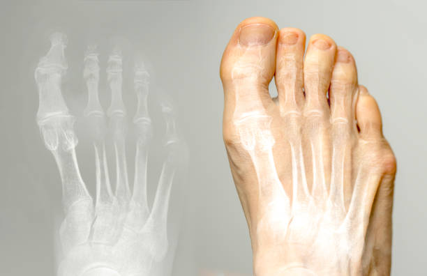 radiographie et le même pied. condition d’hallux varus. - big toe photos et images de collection