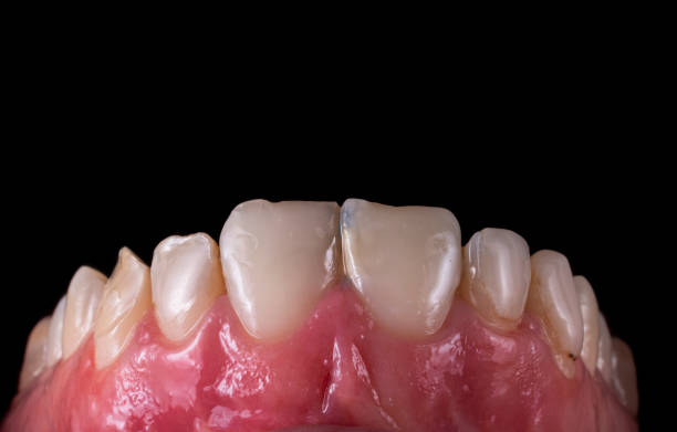 istock dental macro photography before and after picture 1390775018