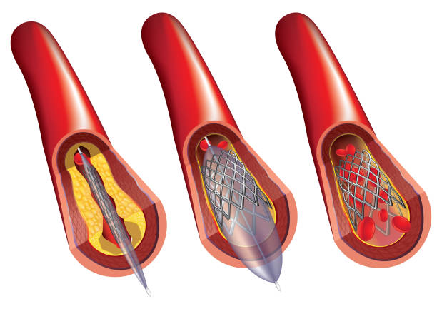 혈관성형술과 스텐트 배치 - angioplasty stock illustrations