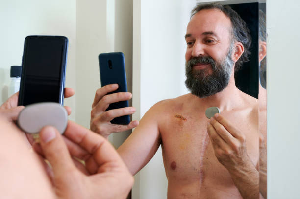 거울에 자화상을 찍는 웃는 수염을 가진 남성 환자가 수술로 인한 상처 근처에서 인공 심장 심박 �조율기를 시연합니다. - pacemaker torso chest male 뉴스 사진 이미지