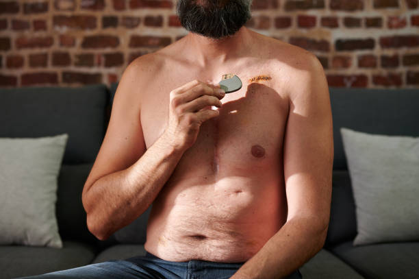 소파에 앉아있는 인식 할 수없는 수염을 가진 남성 환자가 수술로 인한 꿰매어 진 상처 근처에서 인공 심장 심박 조율기를 시연합니다. - pacemaker torso chest male 뉴스 사진 이미지