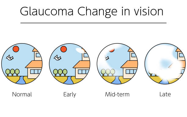 illustrations, cliparts, dessins animés et icônes de illustration du glaucome, changements du champ visuel au fur et à mesure que le glaucome progresse, illustrations médicales - eyes narrowed