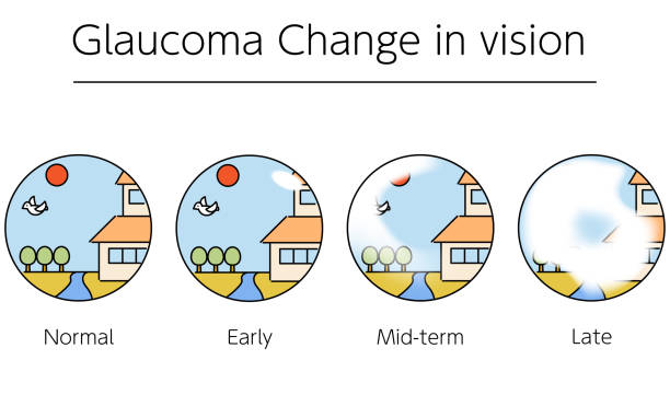 ilustrações de stock, clip art, desenhos animados e ícones de illustration of glaucoma, changes in visual field as glaucoma progresses, medical illustrations - eyes narrowed