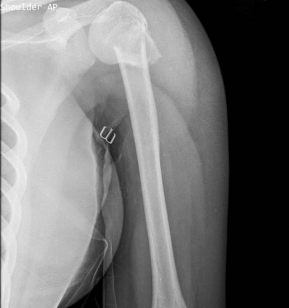 zdjęcie rentgenowskie bliższego złamania kości ramiennej - humerus zdjęcia i obrazy z banku zdjęć