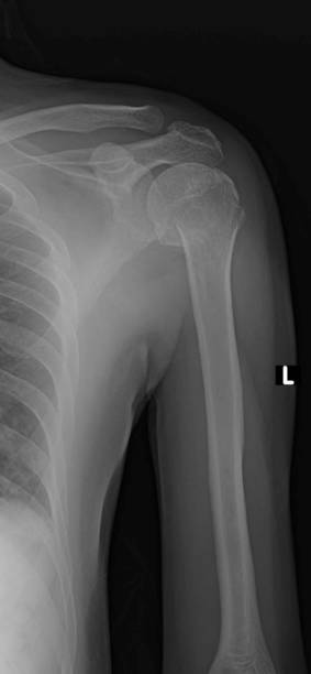 image radiographique d’une fracture de l’humérus proximal - humerus photos et images de collection