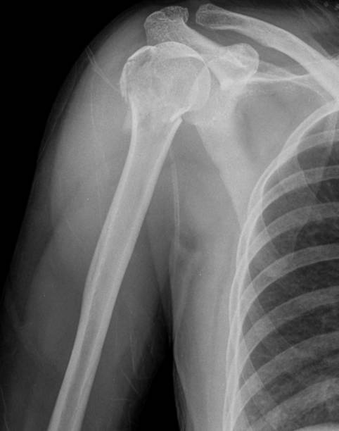 image radiographique d’une fracture de l’humérus proximal - humerus photos et images de collection