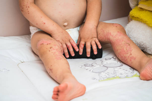 Close up enterovirus on baby body Close up enterovirus on baby body hand foot and mouth disease stock pictures, royalty-free photos & images