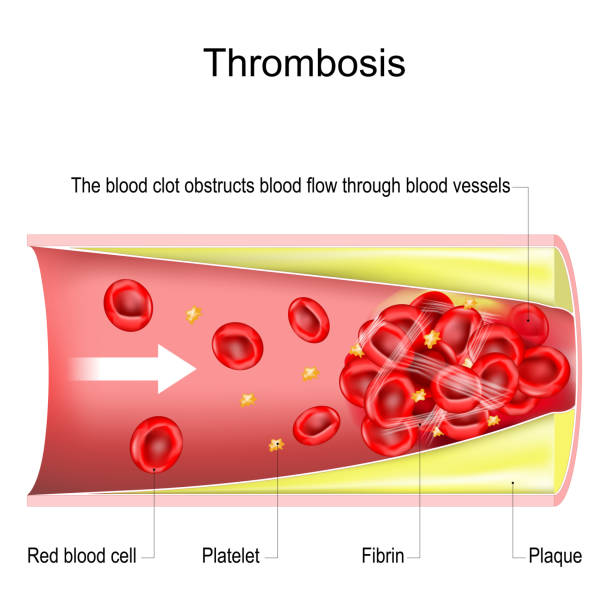 thrombosis. The blood clot obstructs blood flow through blood vessels vector art illustration