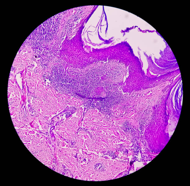 conscientização do câncer endometrial (uterino): fotomicrograph da biópsia uterina mostrando câncer endometrial ou carcinoma endometrial. - endometrial adenocarcinoma - fotografias e filmes do acervo