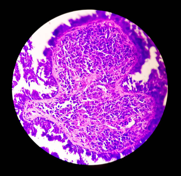 conscientização do câncer endometrial (uterino): fotomicrograph da biópsia uterina mostrando câncer endometrial ou carcinoma endometrial. - endometrial adenocarcinoma - fotografias e filmes do acervo