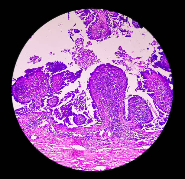 conscientização do câncer endometrial (uterino): fotomicrograph da biópsia uterina mostrando câncer endometrial ou carcinoma endometrial. - endometrial adenocarcinoma - fotografias e filmes do acervo