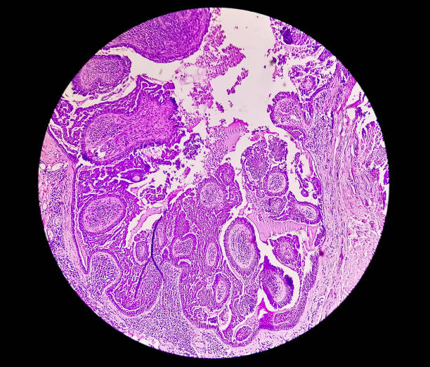 conscientização do câncer endometrial (uterino): fotomicrograph da biópsia uterina mostrando câncer endometrial ou carcinoma endometrial. - endometrial adenocarcinoma - fotografias e filmes do acervo