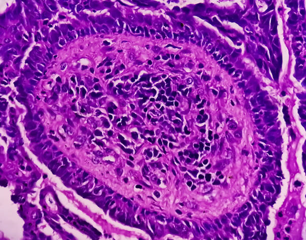 conscientização do câncer endometrial (uterino): fotomicrograph da biópsia uterina mostrando câncer endometrial ou carcinoma endometrial. - adenocarcinoma - fotografias e filmes do acervo