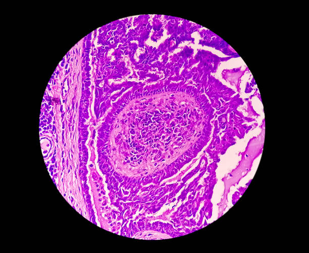 conscientização do câncer endometrial (uterino): fotomicrograph da biópsia uterina mostrando câncer endometrial ou carcinoma endometrial. - endometrial adenocarcinoma - fotografias e filmes do acervo