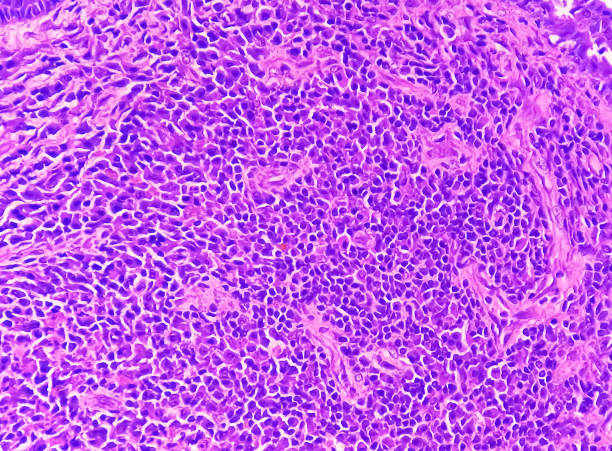 conscientização do câncer endometrial (uterino): fotomicrograph da biópsia uterina mostrando câncer endometrial ou carcinoma endometrial. - endometrial adenocarcinoma - fotografias e filmes do acervo