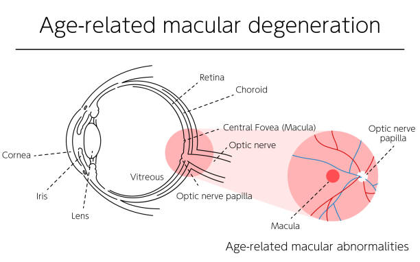 illustrations, cliparts, dessins animés et icônes de illustration d’une maladie oculaire, dégénérescence maculaire liée à l’âge - choroid