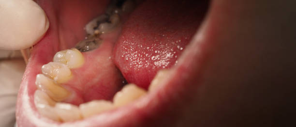 istock Decayed tooth root canal treatment. Tooth or teeth decay of lower molar. Restoration with a composite filling. Adult caries. bad teeth. Dental temporary restorative material. Dental concept. close up. 1391191206