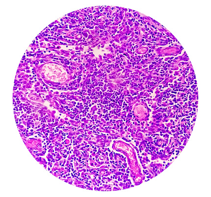 Epithelioid histiocytes view in microscopy criteria of tuberculosis. Chronic granulomatous inflammation. CGI-TB