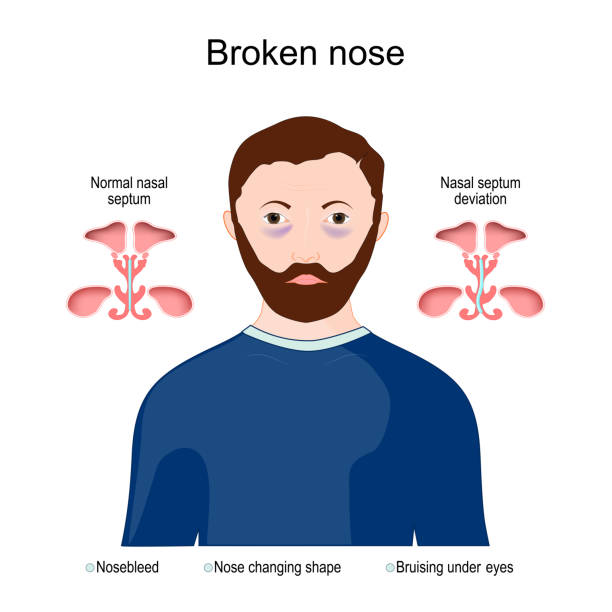Symptoms of a broken nose Symptoms of a broken nose: nose changing shape, Bruising under eyes. comparison of Normal nasal septum and Nasal septum deviation. Vector diagram septum stock illustrations