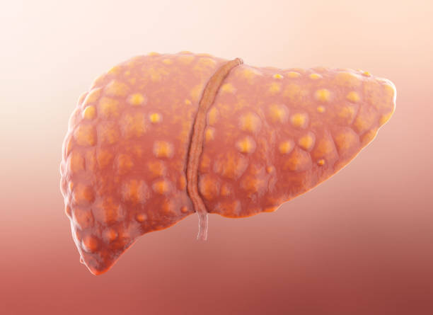 fegato umano con cirrosi. isolato - liver foto e immagini stock