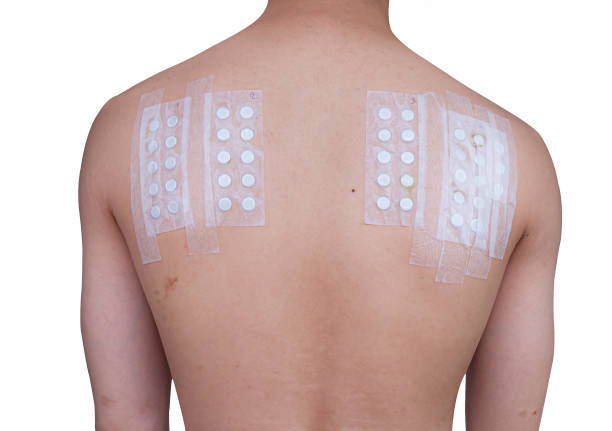 istock Applying Patch Test to test for chronic allergic rash from chemical exposure through skin. Skin allergy test strips. 1391319039