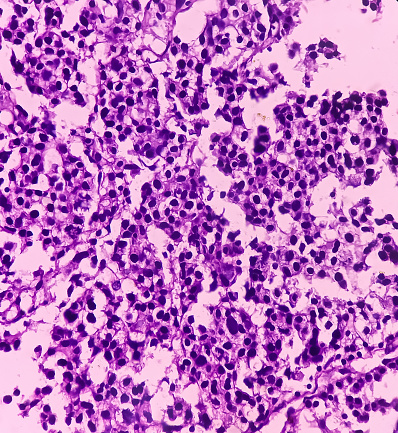 TURBT: Urinary bladder cancer, Transitional cell carcinoma, show urinary bladder mucosa, malignant neoplasm, 40x view
