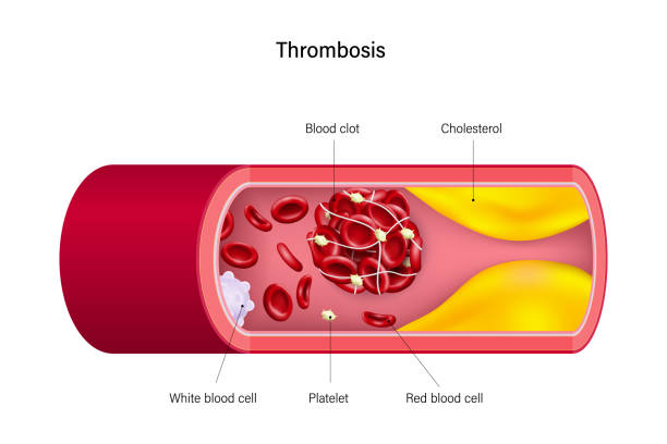 ilustraciones, imágenes clip art, dibujos animados e iconos de stock de trombosis. los coágulos de sangre o trombos bloquean el flujo de sangre. - healthcare and medicine human cardiovascular system anatomy human blood vessel