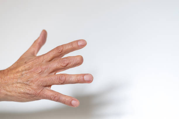 istock Elderly man hand with amputated middle finger 1391692003
